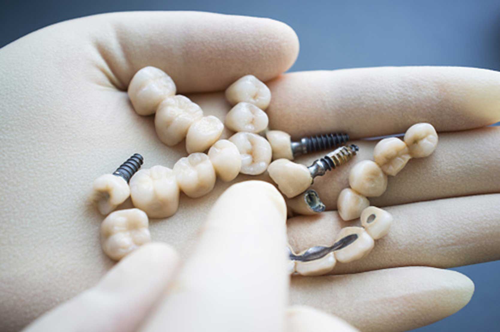 artificial teeth held in the hand of a doctor, mechanical teeth with screws